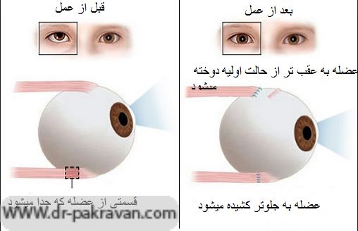 تغییر محل اتصال عضلات خارج چشمی در اعمال جراحی استرابیسم